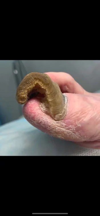اونیکوگریفوزیس (Onychogryphosis)