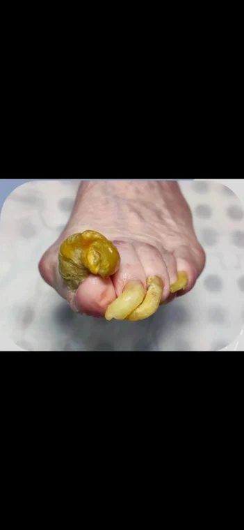 اونیکوگریفوزیس (Onychogryphosis)